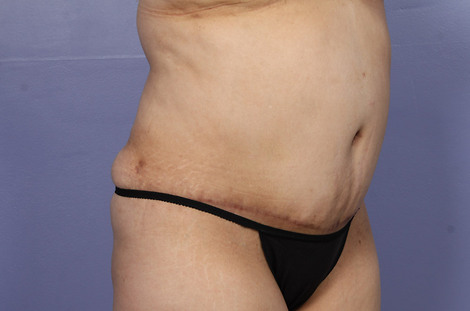 Liposuction before and after photo