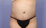 Liposuction Before and after photo