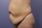 Liposuction Before and after photo