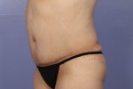 Liposuction Before and after photo