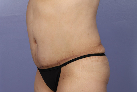 Liposuction before and after photo