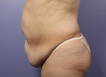 Liposuction Before and after photo