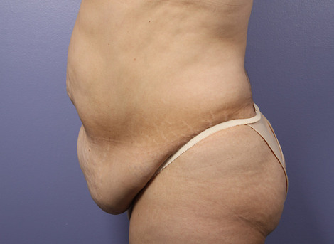 Liposuction before and after photo