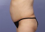 Liposuction Before and after photo