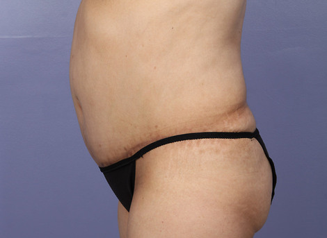 Liposuction before and after photo