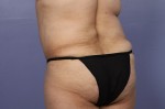 Liposuction Before and after photo