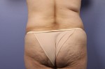 Liposuction Before and after photo