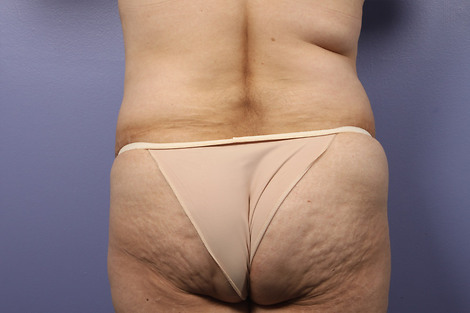 Liposuction before and after photo