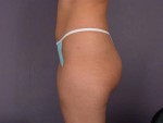 Liposuction Before and after photo