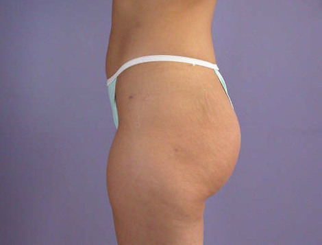 Liposuction before and after photo