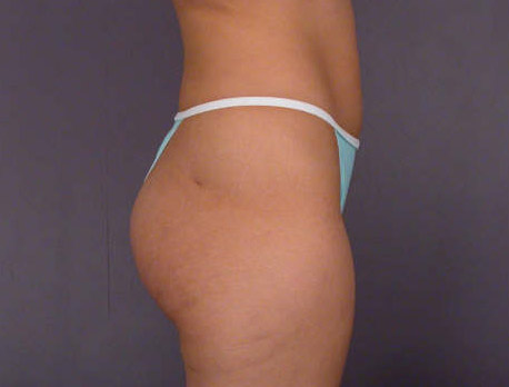 Liposuction before and after photo