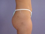 Liposuction Before and after photo