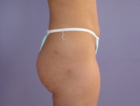 Liposuction before and after photo