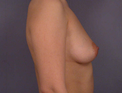 Liposuction before and after photo