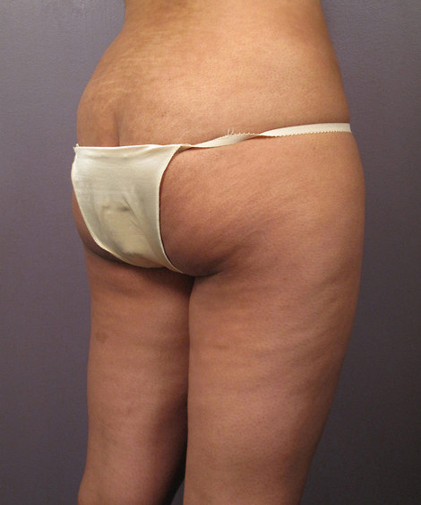 Liposuction before and after photo