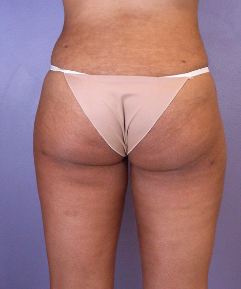 Liposuction before and after photo