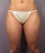 Liposuction Before and after photo