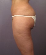 Liposuction Before and after photo