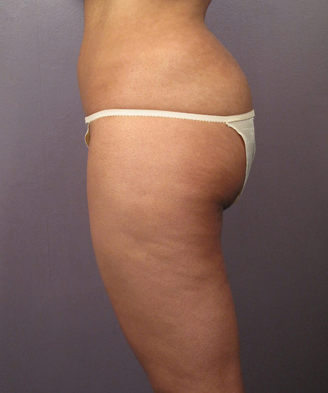 Liposuction before and after photo