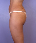 Liposuction Before and after photo