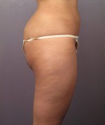 Liposuction Before and after photo