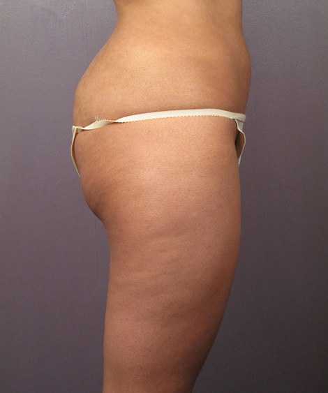 Liposuction before and after photo