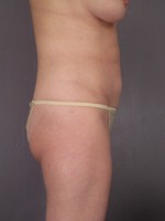 Liposuction Before and after photo