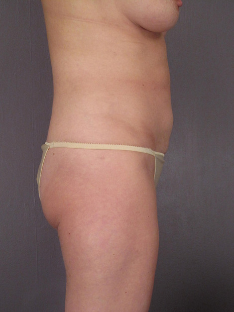 Liposuction before and after photo