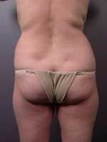 Liposuction Before and after photo