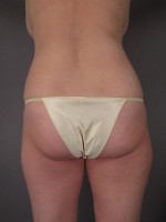 Liposuction Before and after photo