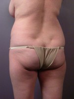 Liposuction Before and after photo