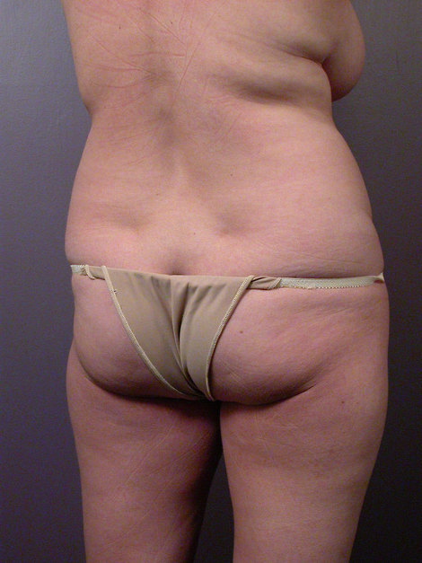 Liposuction before and after photo