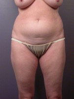 Liposuction Before and after photo