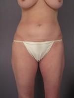 Liposuction Before and after photo