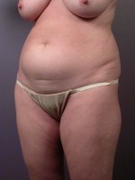 Liposuction Before and after photo