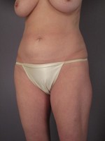 Liposuction Before and after photo