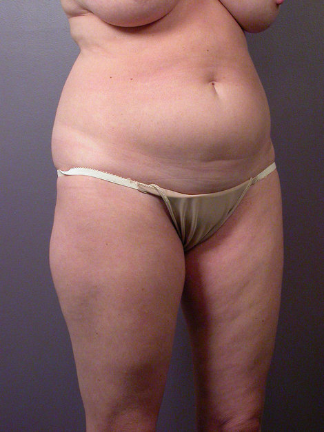 Liposuction before and after photo