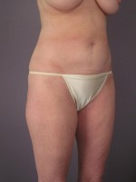 Liposuction Before and after photo