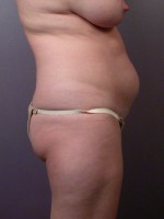 Liposuction Before and after photo