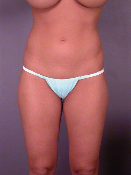 Liposuction before and after photo