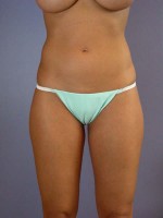 Liposuction Before and after photo