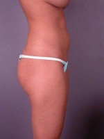 Liposuction Before and after photo