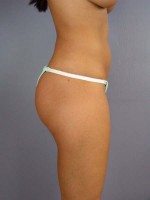 Liposuction Before and after photo