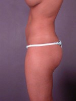 Liposuction Before and after photo