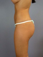 Liposuction Before and after photo