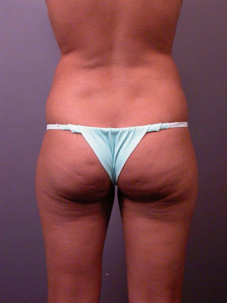 Liposuction before and after photo