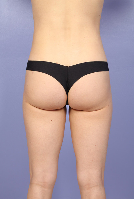 Liposuction before and after photo