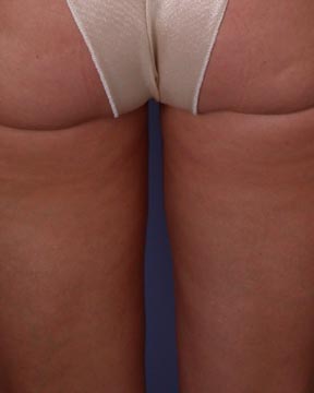 Liposuction before and after photo