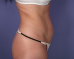 Liposuction Before and after photo