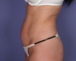 Liposuction Before and after photo